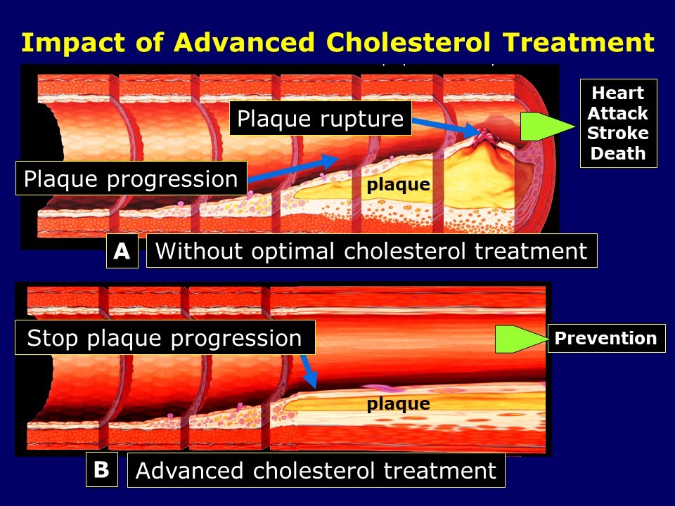 Impact of Advanced Cholesterol Treatment
