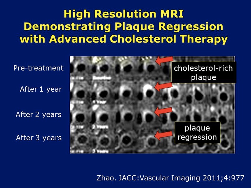 mri-plaque-regression med hr